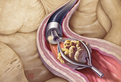 Kidney Stone Removal 