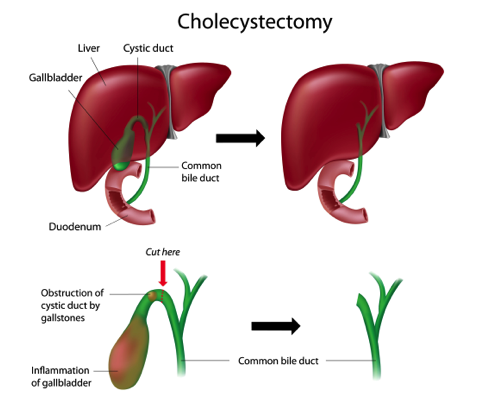 Cholecystectomy