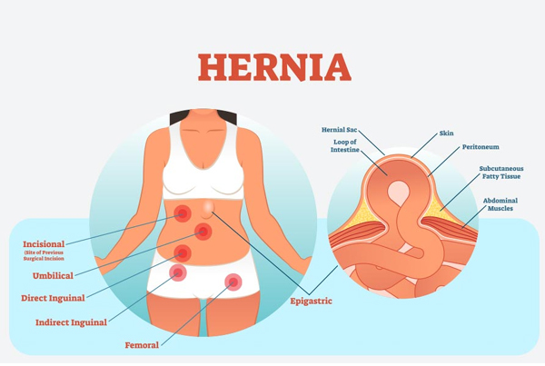 Inguinal Hernia