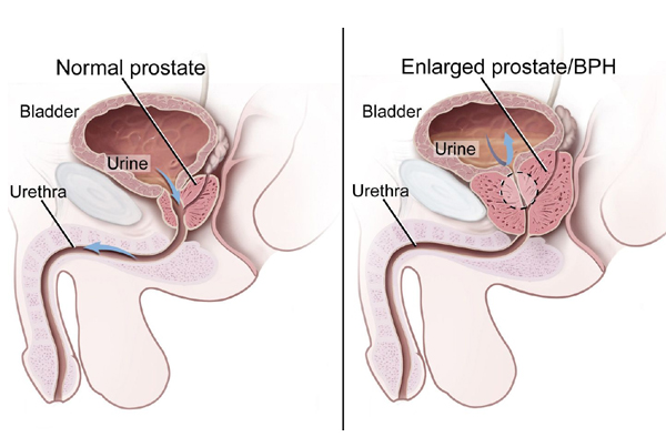 Prostatectomy