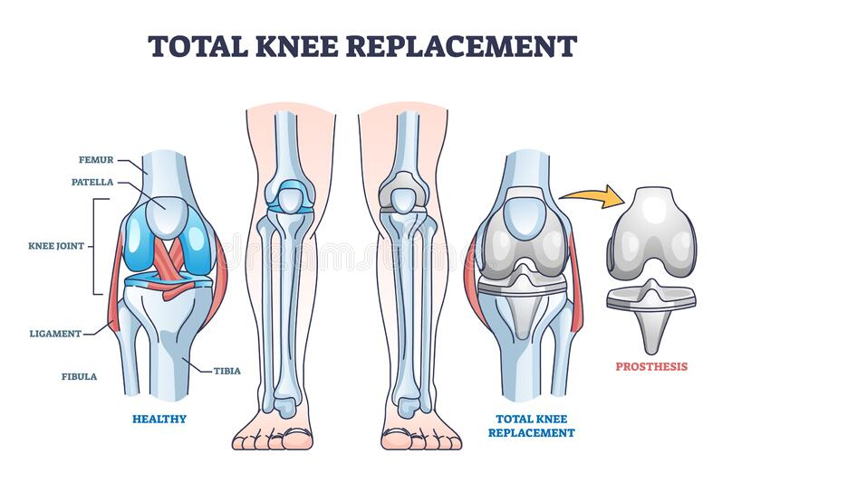 Knee Replacement Surgery