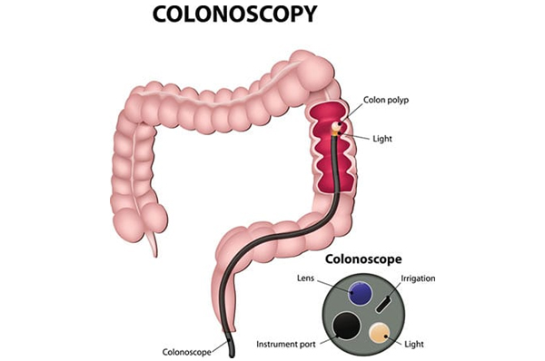 Colonoscopy