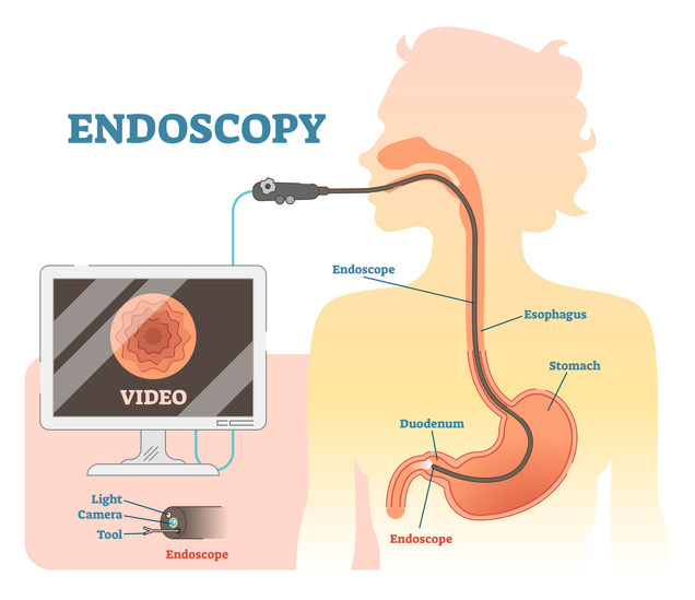 Endoscopy 