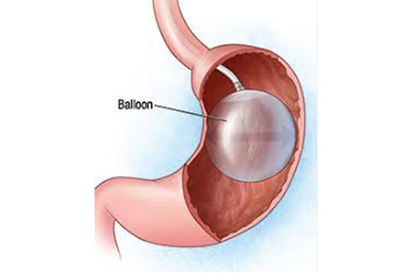 Endoscopic Retrograde Cholangiopancreatography