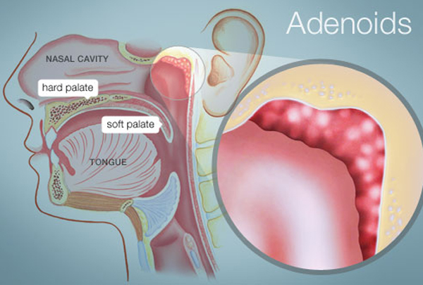 Adenoidectomy