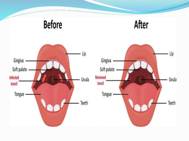 Tonsillectomy