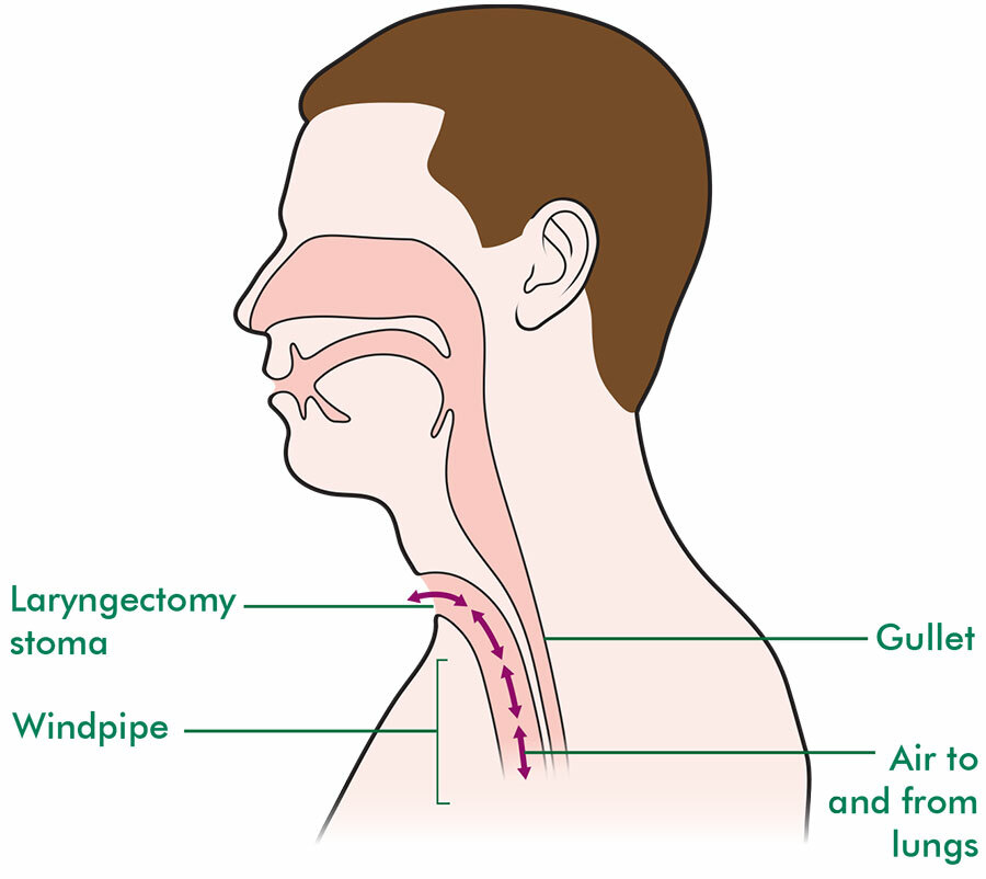 Laryngectomy