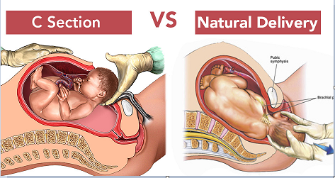 LSCS CAESAREAN SECTION OPERATION