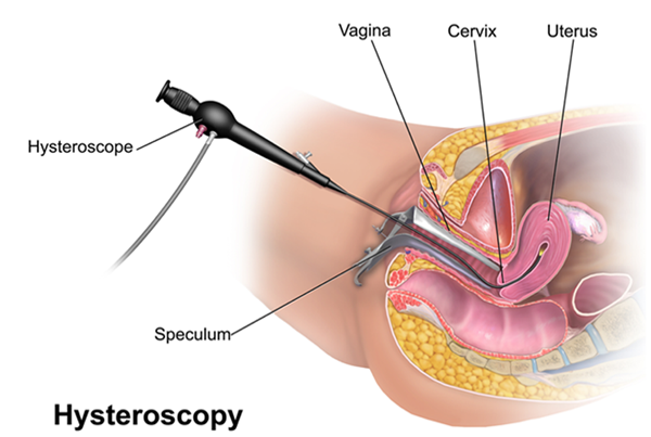 Hysterectomy